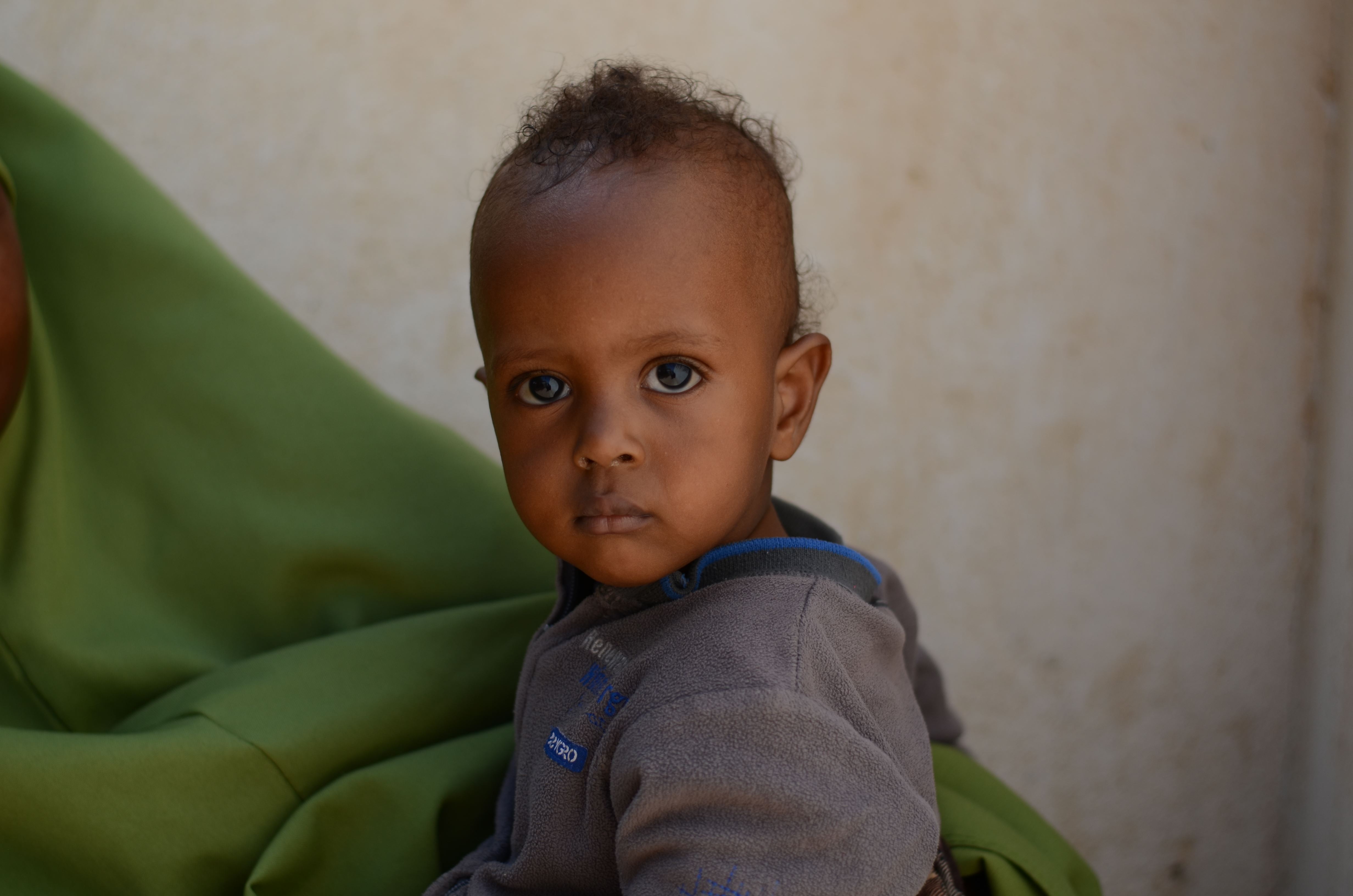 10-month-old Hussein used to be malnourished.